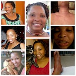 For 3 yrs, CU has dominated my life. This illness has robbed me of my life, my health, my joy, & my figure. I pray that an effective treatment/ cure is found soon. 
(Left pics: before CU, center: present, right: Hives w/ angioedema)
