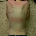 7 years old and suffered with Urticaria Dermographia for 2 years. Would love to have more awareness of Urticaria as took over a year to get diagnosed!