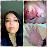Hello, my name Ilenia , I have 32 years and suffer hives since I was a child. There was a period from 5 to 21 did not return to me any episode, but after delivery , every time my child gets sick and gives me some infection in my throat , I filled urt